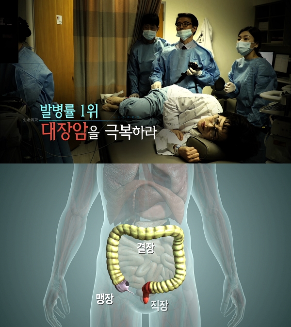 ‘생로병사의 비밀’ 달라진 대장암 지형도, 젊은 대장암이 늘고 있다